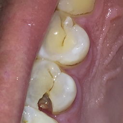 牙齿开裂是什么原因治疗方法,牙齿轻微裂缝怎么治