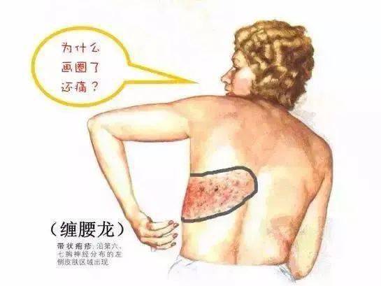 带状疱疹俗称缠腰龙「带状疱疹为什么叫做缠腰龙在腰上连成一圈人就不行了吗」