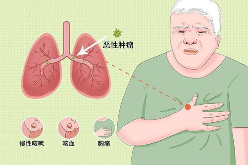肺癌一经发现就是晚期身体3处疼痛莫忽视可能是肺部病变信号